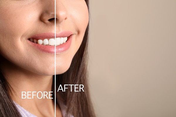 Cosmetic Dental Reasons For A Gum Reshaping Procedure