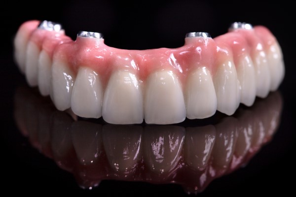 Will I Need A Bone Graft For The All On   Procedure?