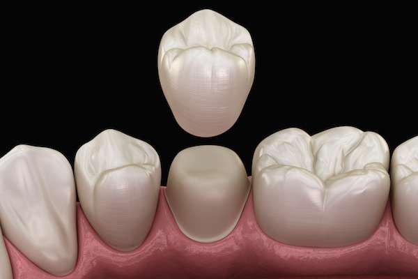 What To Ask Your General Dentist When Preparing for a Crown from Luna Dental in McAllen, TX