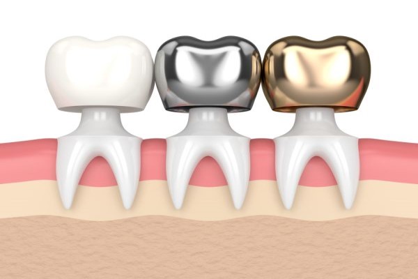 Metal Crowns Vs  Porcelain Dental Crowns