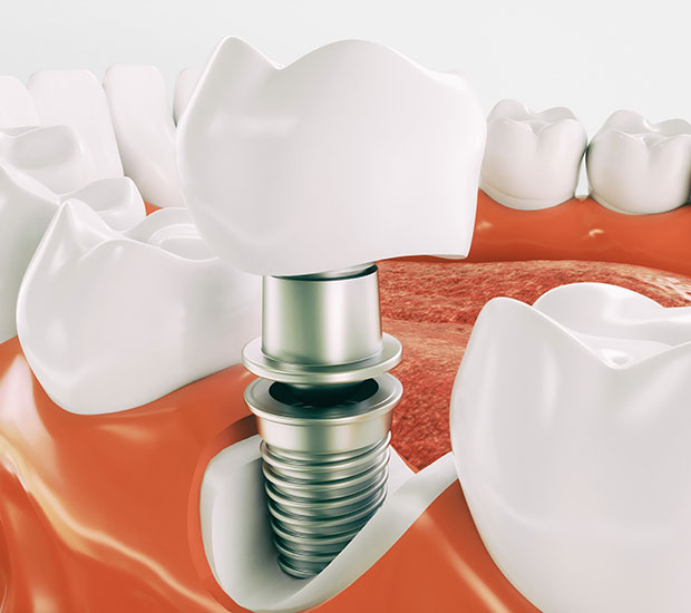 McAllen Dental Implant Restoration