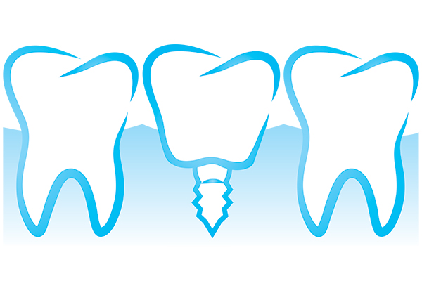 Can Multiple Dental Implants Be Placed At The Same Appointment?