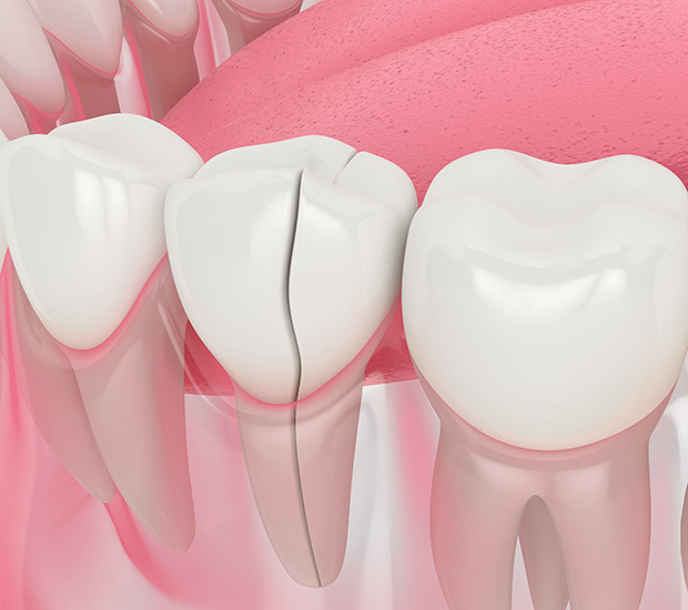 McAllen Types of Dental Root Fractures